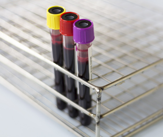 Provette di sangue pronte per l’analisi ematologica, rappresentazione delle attività diagnostiche nel laboratorio della Casa di Cura Quisisana
