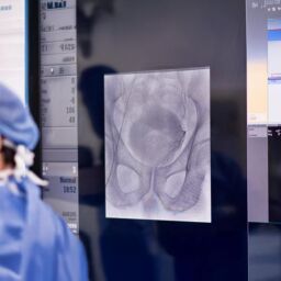 embolizzazione della prostata