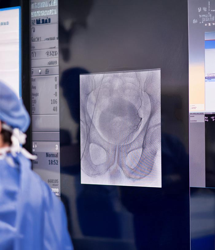 embolizzazione della prostata