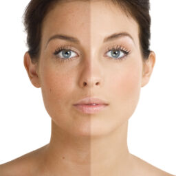 Confronto visivo dei danni del fotoinvecchiamento sul viso: a sinistra pelle con macchie solari e rughe, a destra pelle sana e levigata